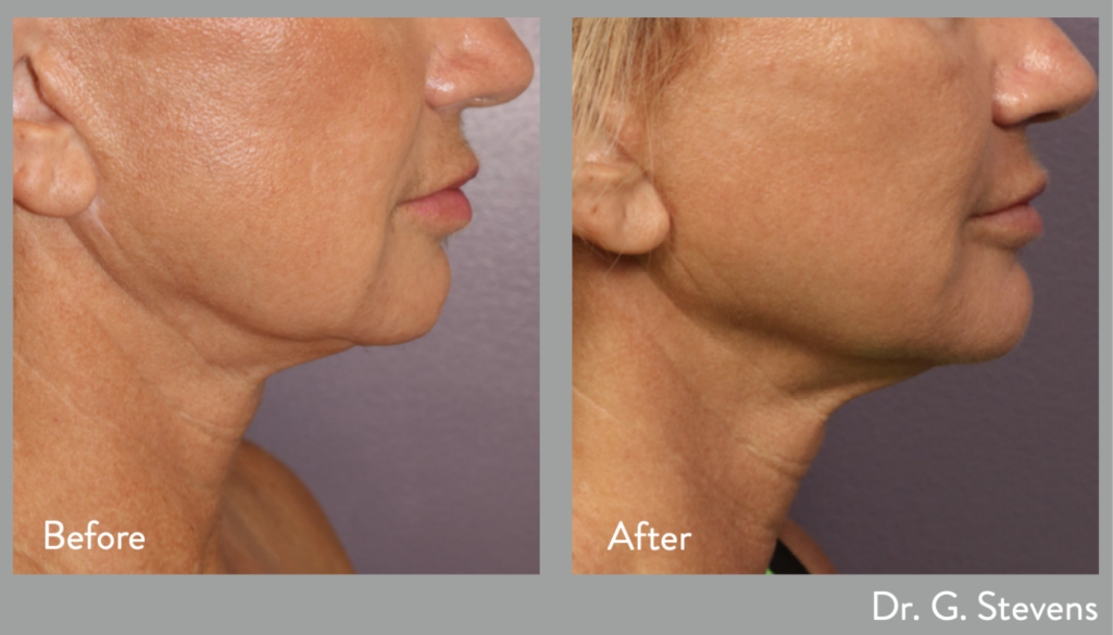 Morpheus8 Radiofrequency Microneedling | Solutions IV Boutique & Medispa